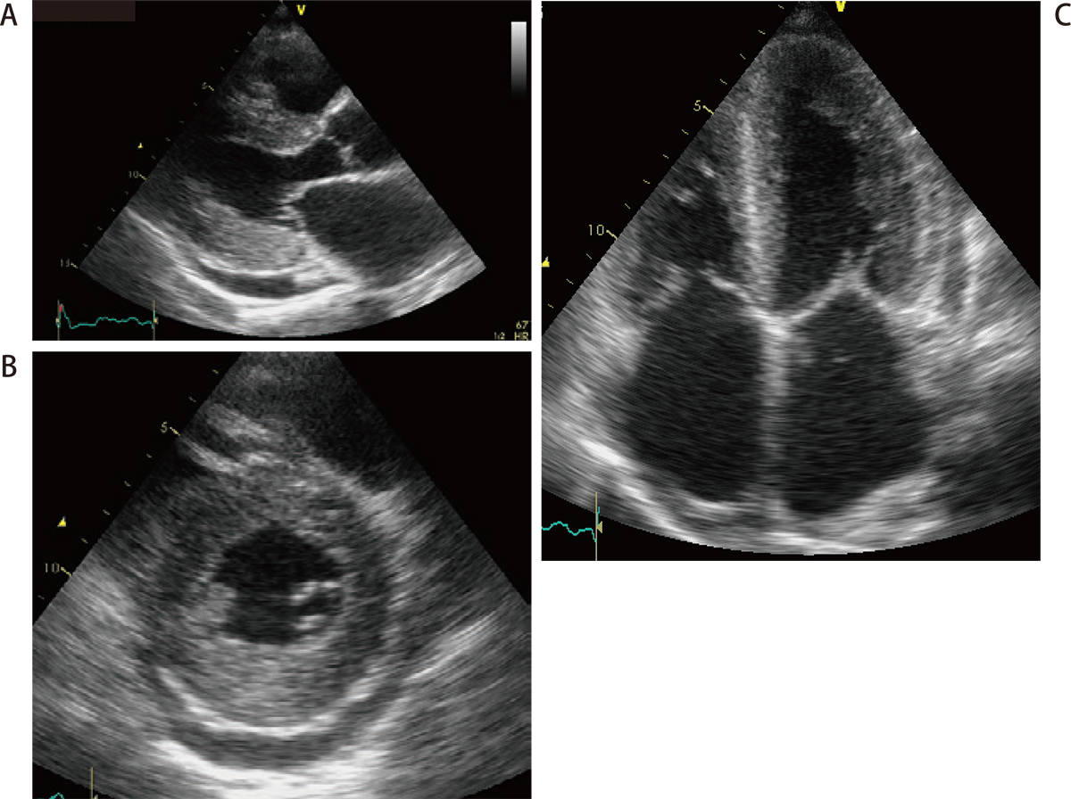 心アミロイドーシスの胸骨左縁長軸像（A）、胸骨左縁短軸像（B）および心尖部4 腔像（C）