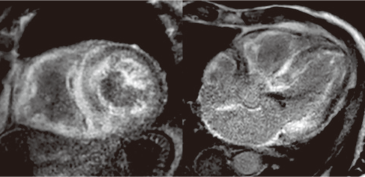 心アミロイドーシスの遅延造影MRI