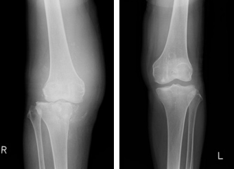膝のCharcot関節